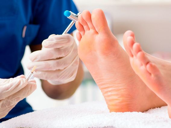 clinica-del-pie-podologo-alcobendas-zulema-martinez-papiloma