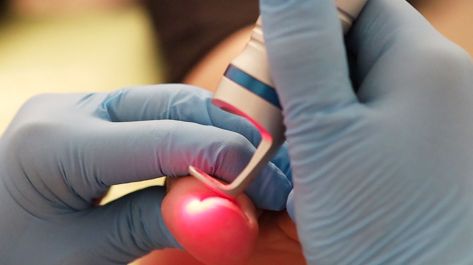 clinica-del-pie-podologo-alcobendas-zulema-martinez-tratamiento-laser